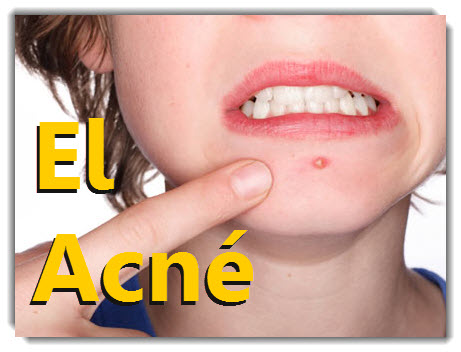 El Acné