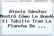 Ver alexis sanchez mostro como le quedo el tobillo tras la plancha de <b>Alexis Sánchez</b> Mostró Cómo Le Quedó El Tobillo Tras La Plancha De ...