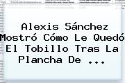 <b>Alexis Sánchez</b> Mostró Cómo Le Quedó El Tobillo Tras La Plancha De ...