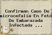 Confirman Caso De <b>microcefalia</b> En Feto De Embarazada Infectada <b>...</b>