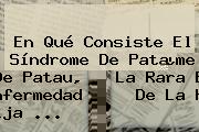 En Qué Consiste El <b>Síndrome De Patau</b>, La Rara Enfermedad De La Hija ...
