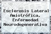 <b>Esclerosis Lateral Amiotrófica</b>, Enfermedad Neurodegenerativa