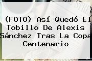 (FOTO) Así Quedó El Tobillo De <b>Alexis Sánchez</b> Tras La Copa Centenario