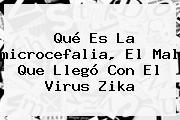 Qué Es La <b>microcefalia</b>, El Mal Que Llegó Con El Virus Zika