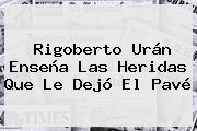 <b>Rigoberto Urán</b> Enseña Las Heridas Que Le Dejó El Pavé