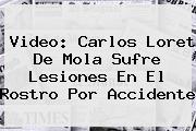 Video: Carlos <b>Loret De Mola</b> Sufre Lesiones En El Rostro Por Accidente